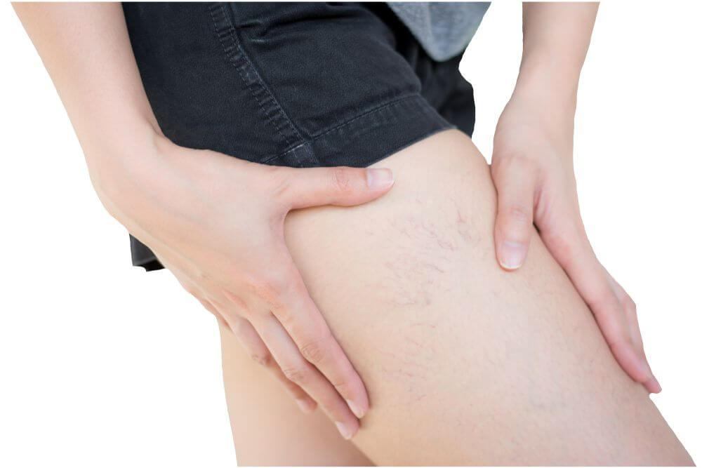 Varizes nas pernas: conheça os sintomas, saiba como previnir e como tratar  • Ana Maria Braga